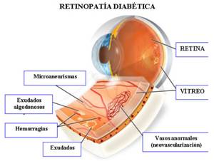 retinopatia diabetica